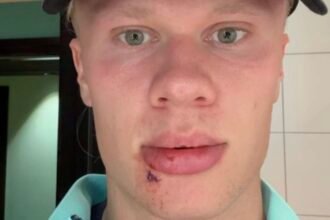 Erling Haaland se blesse… en descendant du bus.