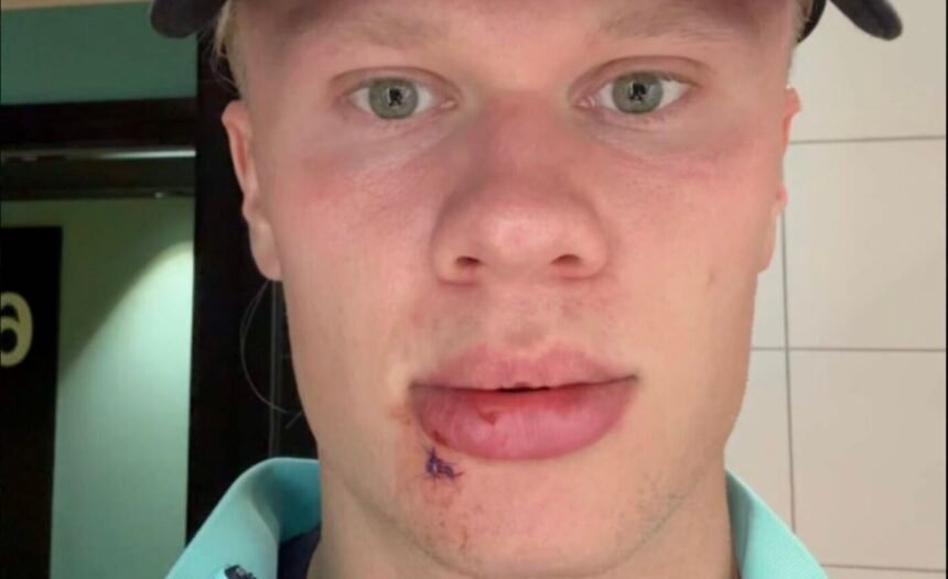 Erling Haaland se blesse… en descendant du bus.